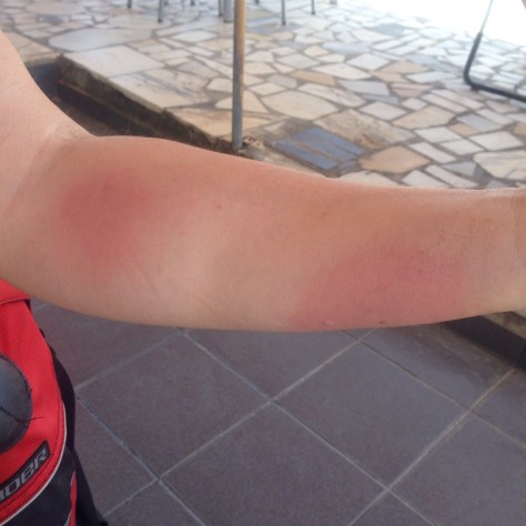 Steve was bitten by something while riding. Ouch!