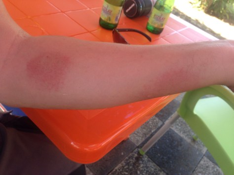 Four days after being bitten Steve still has redness. 